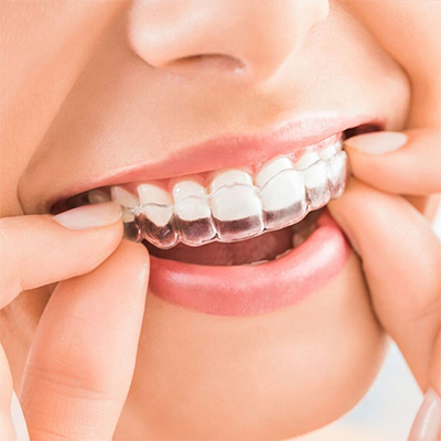 Invisalign Invisalign