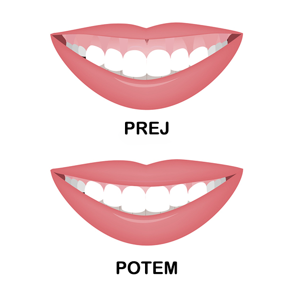 Preoblikovanje-dlesni-2 Preoblikovanje-dlesni-2