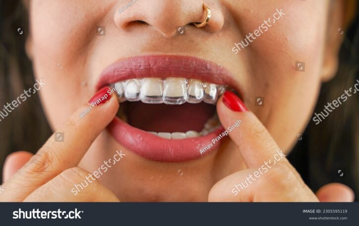 invisalign-2305595119