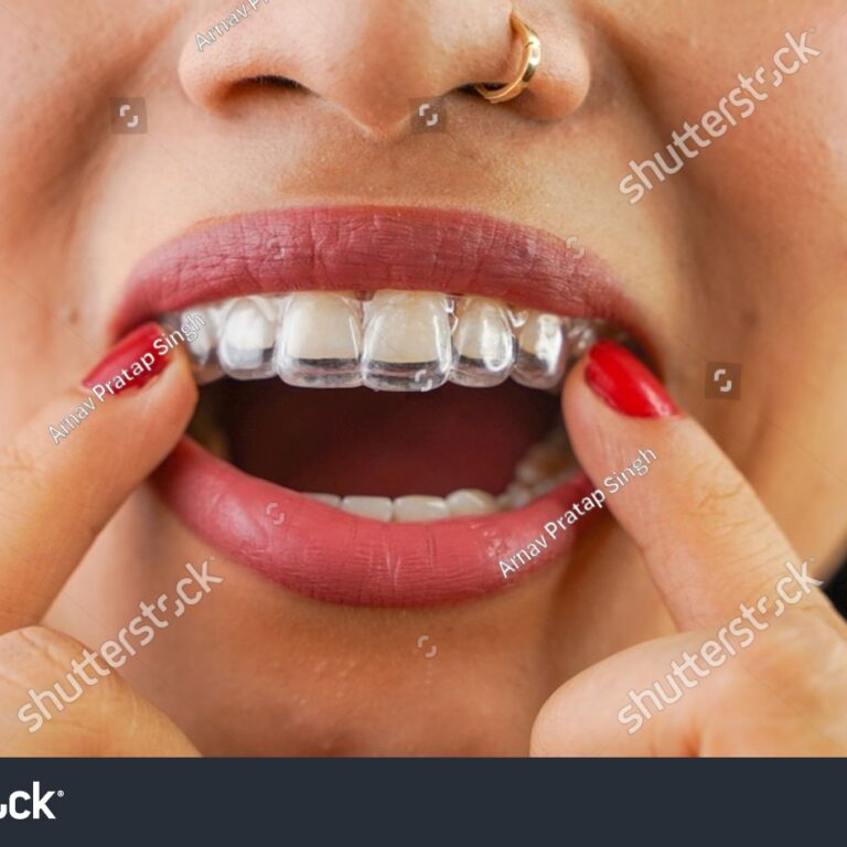 invisalign-2305595119
